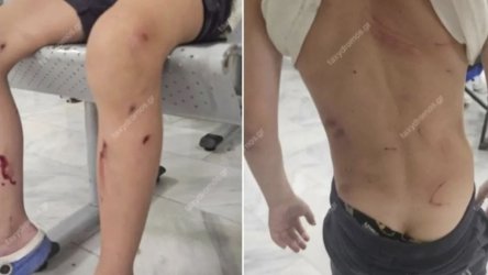 Βόλος: Αδέσποτα σκυλιά επιτέθηκαν σε 7χρονο – Τον δάγκωσαν σε όλο το σώμα