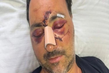 Ελεύθεροι και οι δύο για τον άγριο ξυλοδαρμό Ελληνοκαναδού χρηματιστή
