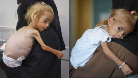 Ιταλία: Σοκαριστικές εικόνες με κοριτσάκι από τη Γάζα που αναρρώνει από υποσιτισμό – Πάσχει από σπάνια ασθένεια
