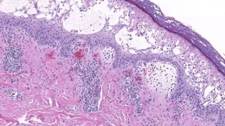 ΗΠΑ: Μεγάλη ανησυχία για την μεταδοτική ασθένεια σε χέρια, πόδια και στόμα σε σχολεία του Τενεσί