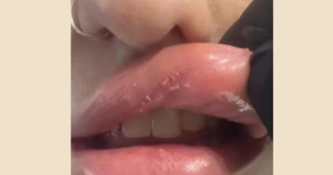 Πάτρα: Έβαλε υαλουρονικό σε νυχάδικο και παραμορφώθηκε – «Χρησιμοποιούν κινέζικα υλικά»