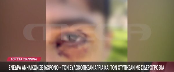 Άγρια επίθεση ανηλίκων σε 16χρονο με σιδερογροθιά στα Ιωάννινα